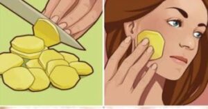 I’m SHOCKED It Removed My Dark Spots In 3 Days, Magic Remedy – TOTAL